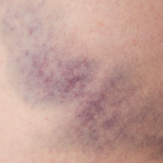 Inre blödningar: orsak, symtom & behandling